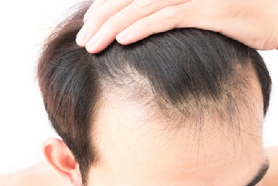 脱发是什么原因导致的 方便面吃多了容易脱发