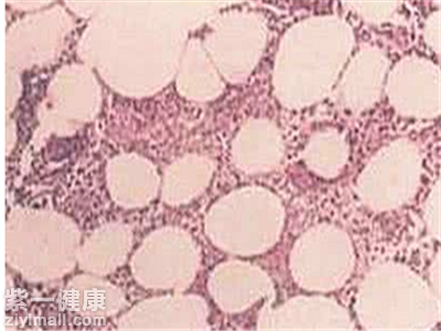 结节性红斑应该怎么预防复发 祛除诱因是关键
