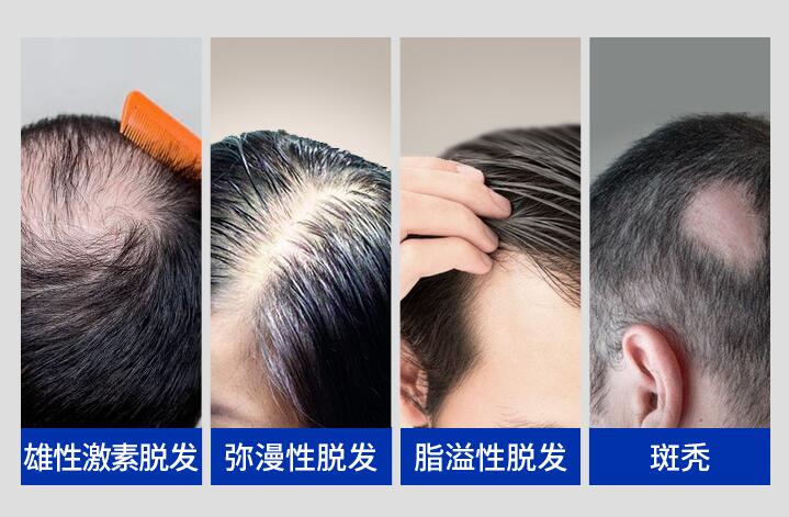 男性脱发是什么原因 男性脱发的5个重要原因