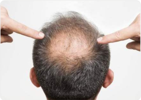 怎样预防脂溢性脱发 5点轻松预防脂溢性脱发