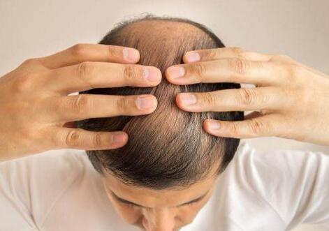 脂溢性脱发怎么办 四招控制脂溢性脱发