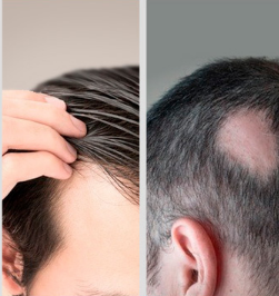 掉头发是什么病 详解病因和治疗方法