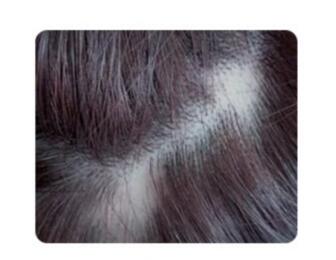 脂溢性脱发是怎么回事 4个原因引起脂溢性脱发