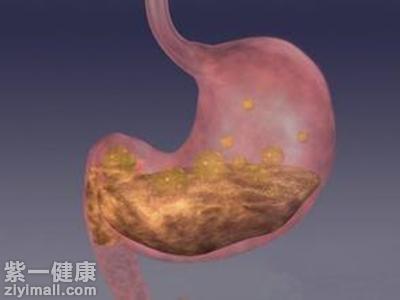 怎样治胃酸过多 【科普】多种治疗胃酸的方法